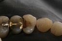 Brandon Yokota #12 caries removal