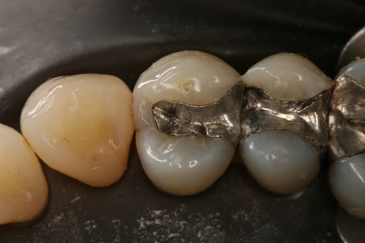 Carla Fukumoto #5 pre-op with dam