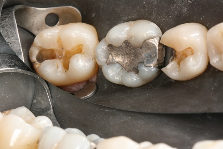 Ted Kanamori #29, 31 caries removal