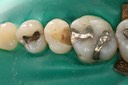 MItchell Chun #4 caries removal