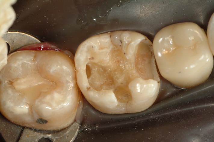 Larry Fujioka #30 amalgam removal