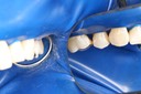 Mark Chun #14 buccal view 2
