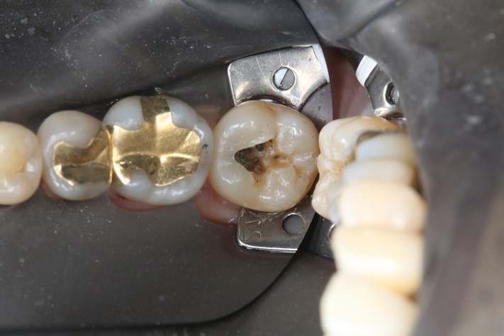 Chris Woo #18 amalgam removal