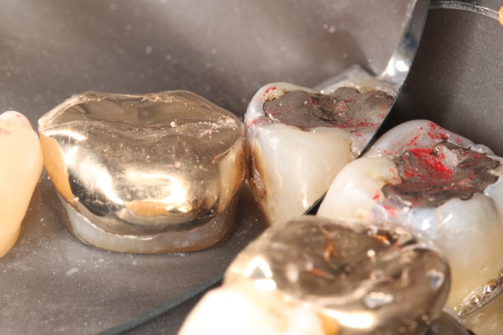Alan Chinn #31 buccal view