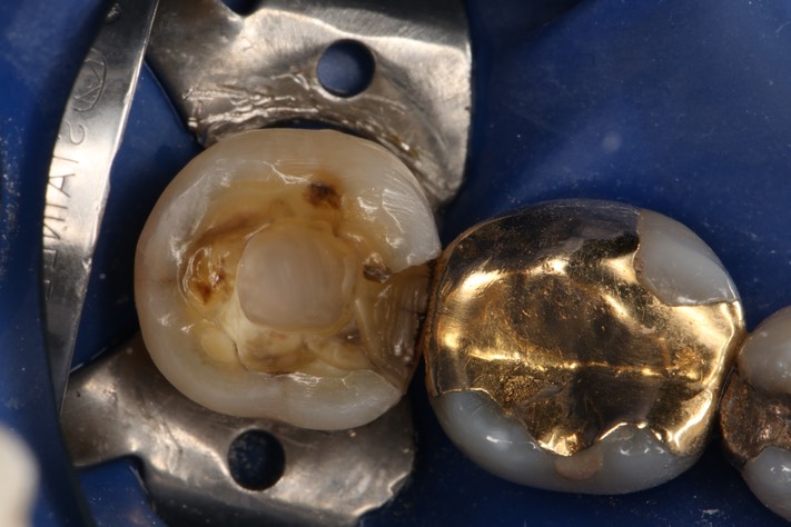 Mark Chun #31 amalgam removal