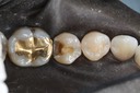 Brian Sato #29 amalgam removal