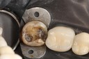 Wayne Chin #31 amalgam removal