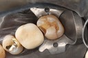 Kyle Chock #2 composite removal