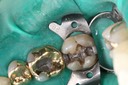 Mendel Sato #18 amalgam removal