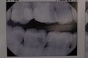 Gary Umeda #2,3 bitewing radiograph