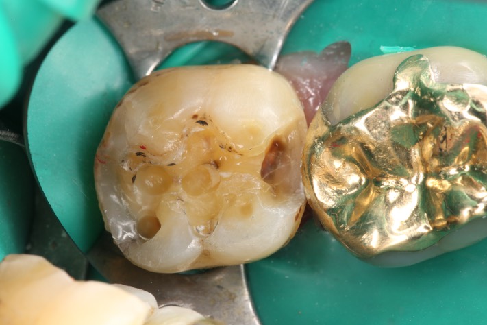 Alan Tamashiro #31 amalgam removal