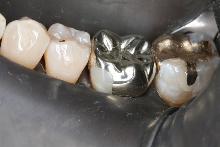 Ted Kanamori #19 finish - buccal view