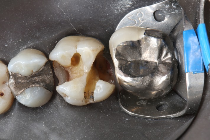 Frank Fukuda #3 caries removal