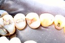 Alan Chinn #12 caries removal