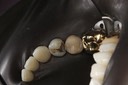 Wayne Chin #21 caries removal