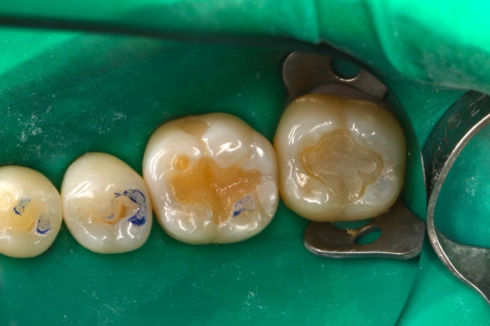 Ted Kanamori #18-19 pre-op