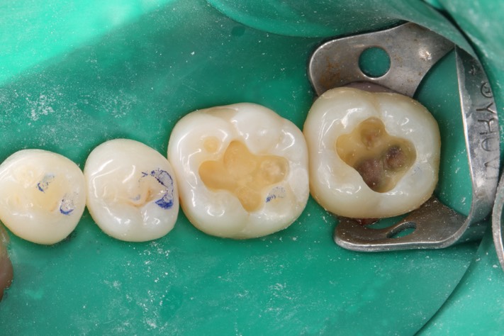 Ted Kanamori #18-19 caries removal
