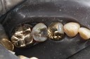 Brian Sato #29 caries removal