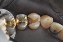 Alan Tamashiro #12 amalgam removal
