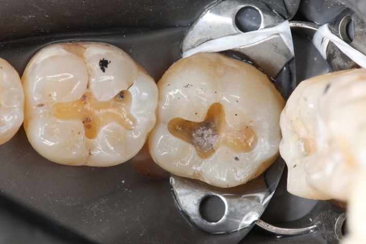 Chris Woo #18 - 19 caries removal