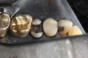 Mendel Sato #13 amalgam removal