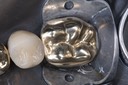 Wayne Chin #21 finish - distal partial view
