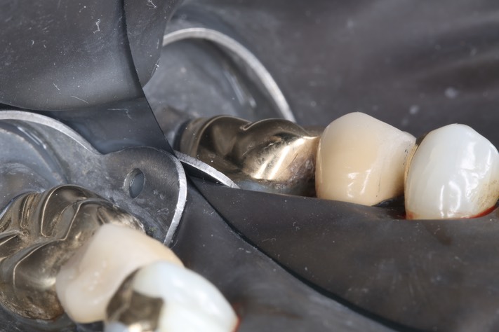 Wayne Chin #21 finish - buccal view