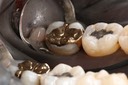 Larry Fujioka #31 finish - lingual view