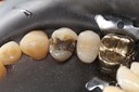 Wes Sato #5 amalgam removal