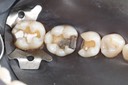Ted Kanamori #30 amalgam removal