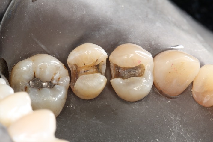 Kyle Chock #12, 13 caries removal