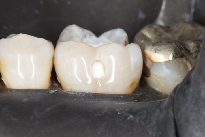 Gary Umeda #19 buccal prep