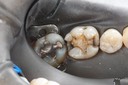 Frank Fukuda #30 caries removal