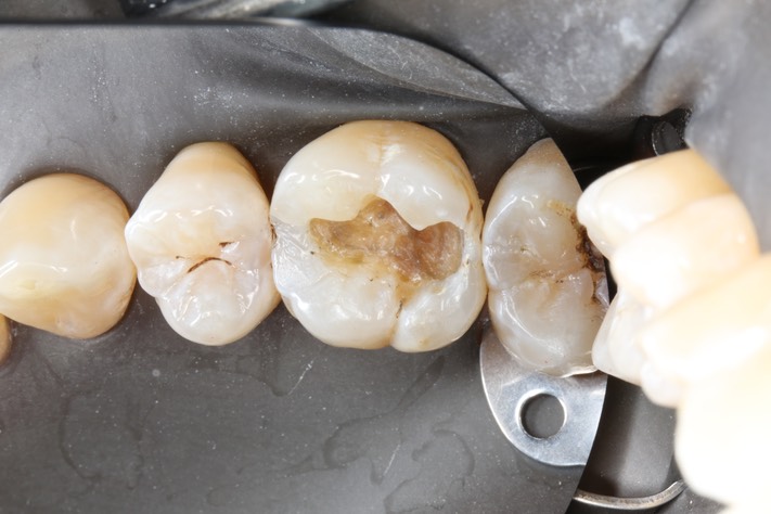 Alan Chinn #3 caries removal 2