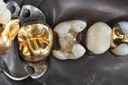 Kyle Chock #14 caries removal