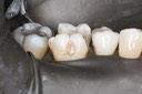 Frank Fukuda #30 buccal prep