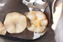 Alan Tamashiro #18 caries removal