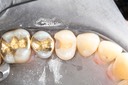 Chris Woo #12 caries removal