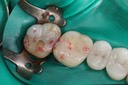 Mendel Sato #15 pre-op