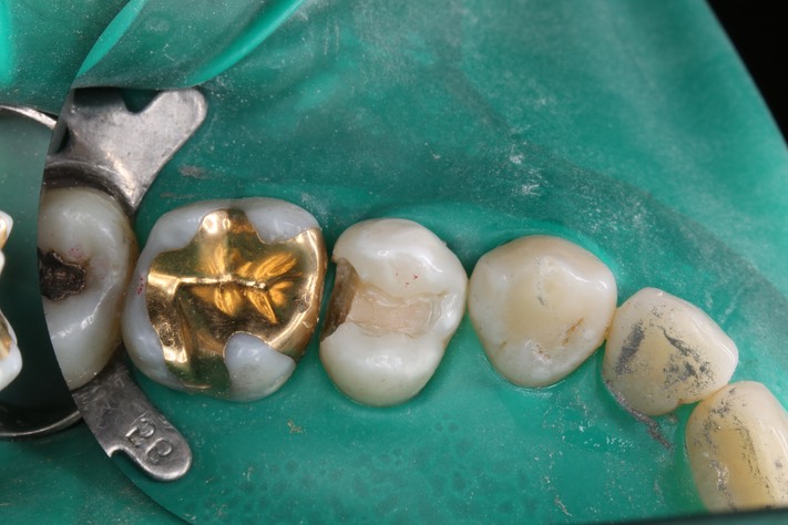 Bryan Sato #13 caries removal