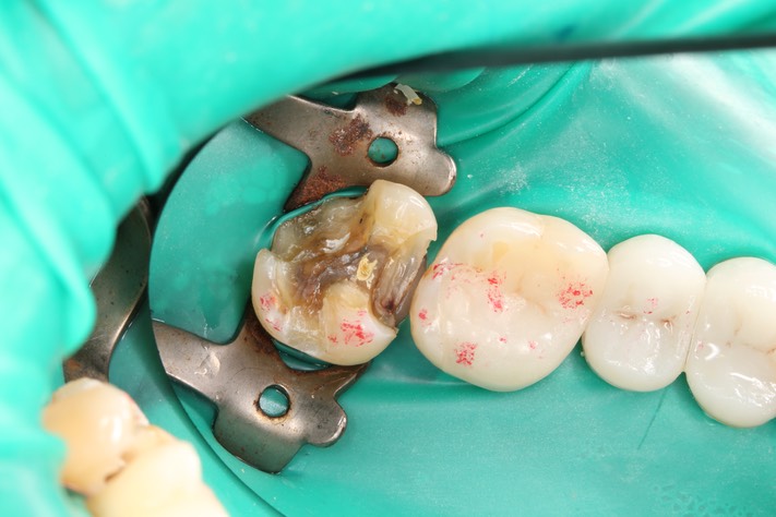 Mendel Sato #15 caries removal