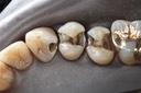 Larry Fujioka #4,5,6 caries removal