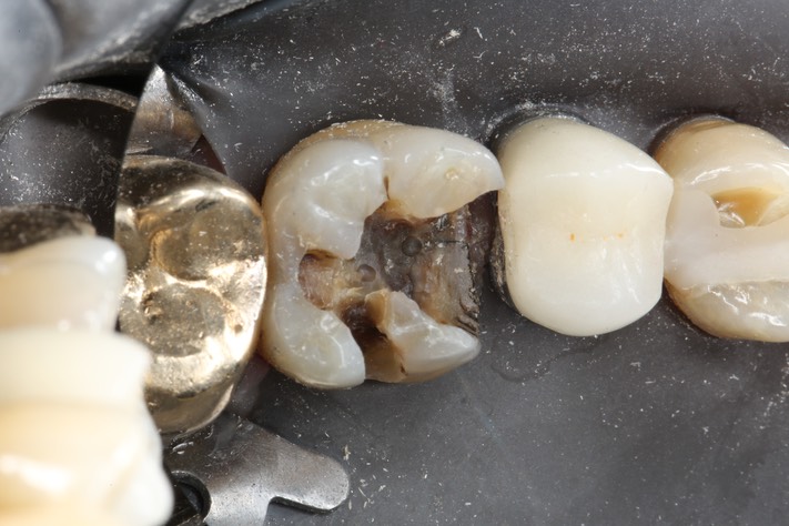 Wes Sato #14 caries removal