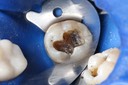 Mark Chun #17 amalgam removal