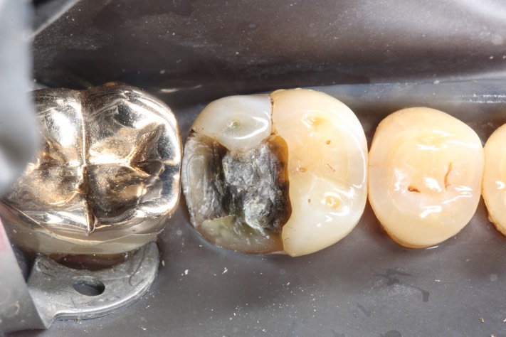 Larry Fujioka #30 amalgam removal