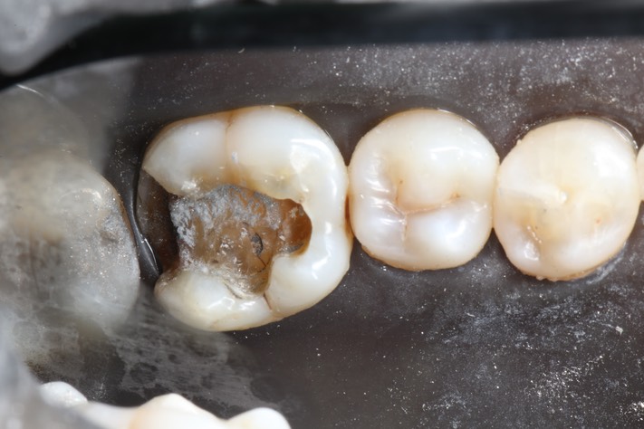 Brian Sato #30 amalgam removal