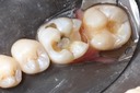 Gary Umeda #18-19 composite removal