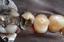 Chris Woo #13 caries removal