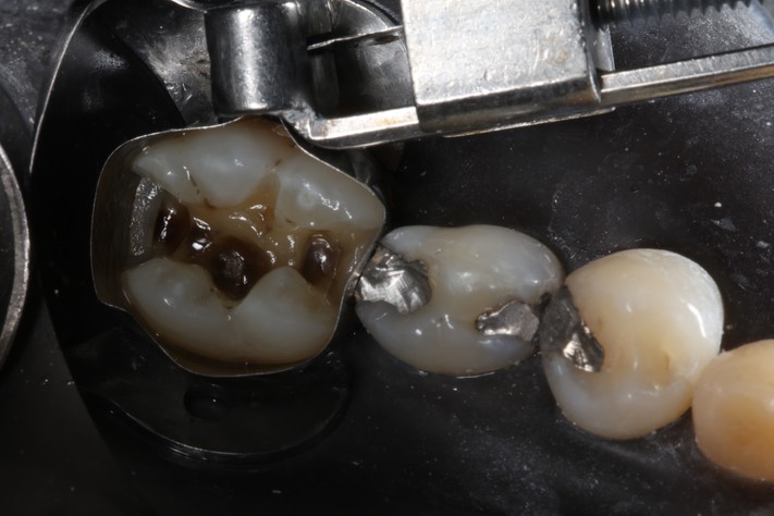 Wayne Chin #30 amalgam removal