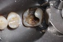 Matt Dodson #19 amalgam removal